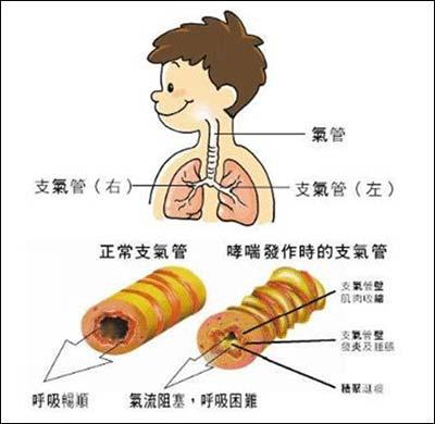 支气管痉挛