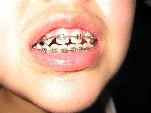牙齿缝隙大是什么原因分析