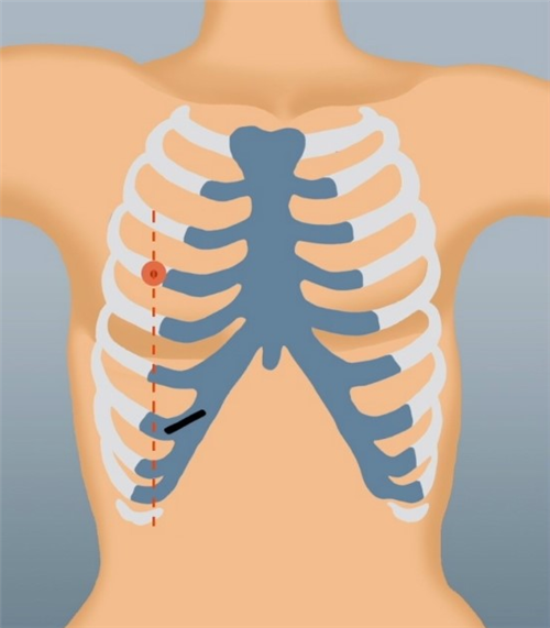 肋软骨炎的症状位置图片