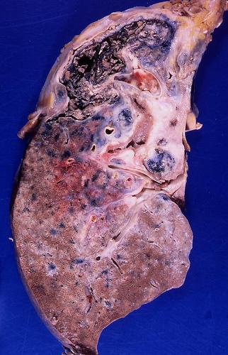 肺图片真实照片图片
