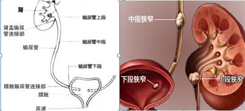 男性尿道三个狭窄图片图片