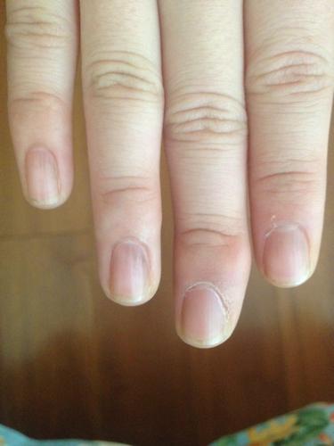 手指甲为什么会凹下去