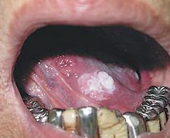 口腔粘膜结节状图片图片