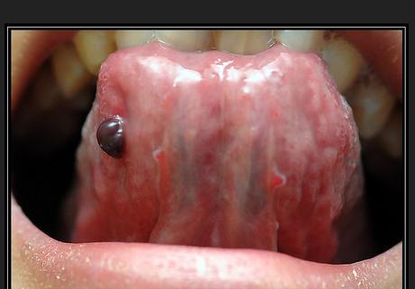 舌头底下有血泡图片图片