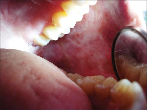 口腔黏膜纤维化吃什么药口腔黏膜纤维化的治疗口腔黏膜纤维化怎么恢复
