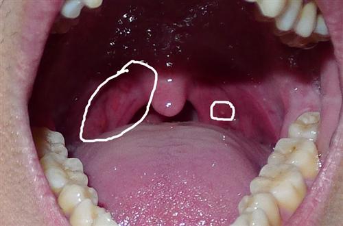 咽部有异物感是怎么回事呢?