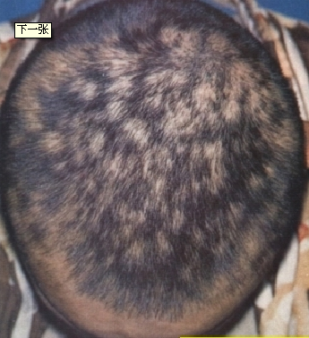 梅毒掉头发属于哪一期图片