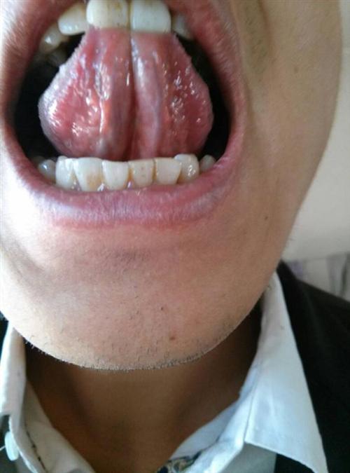 女性梅毒舌头图片图片