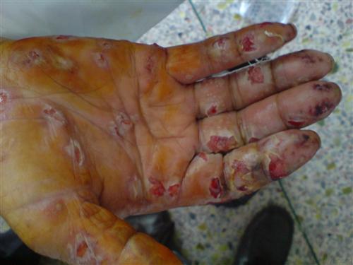 皮肤软组织感染