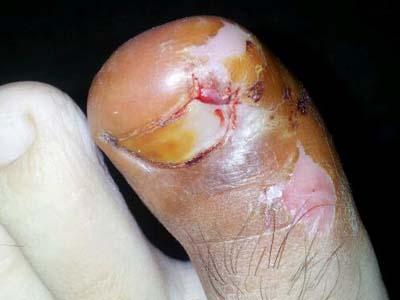 皮肤软组织感染