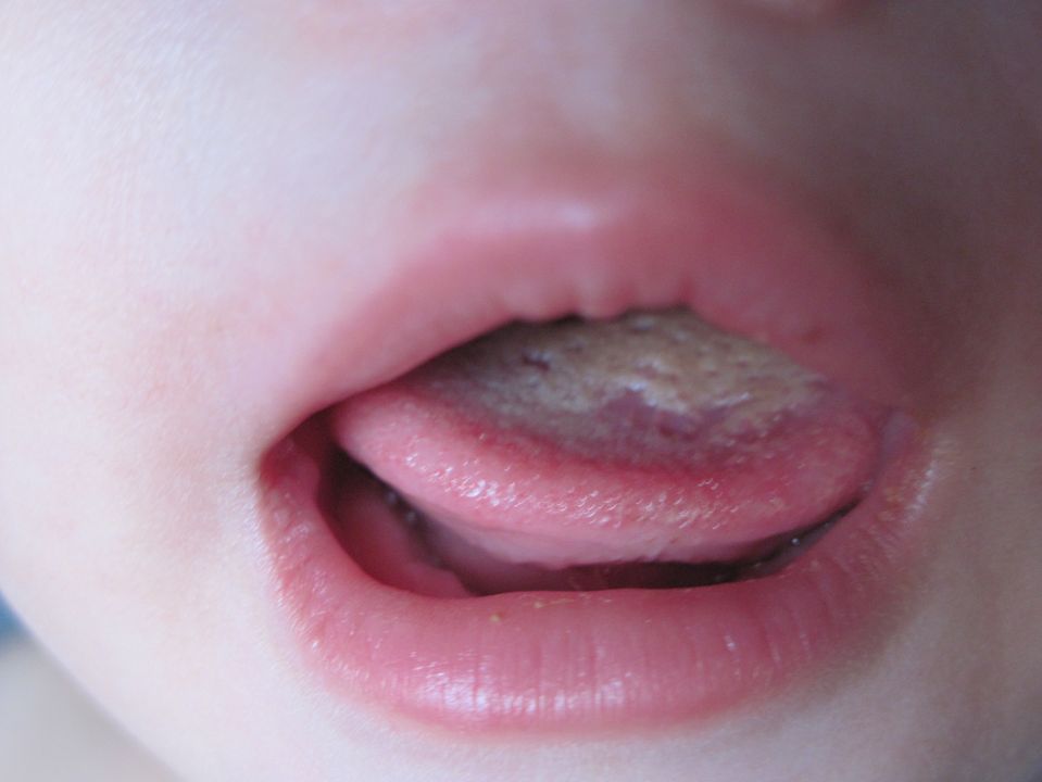 宝宝口舌生疮症状图片图片