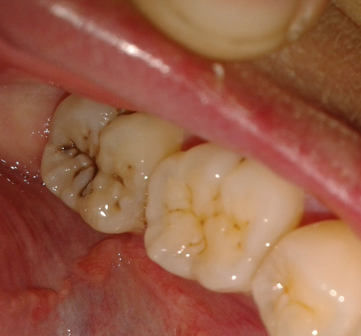 窝沟龋齿初期图片图片