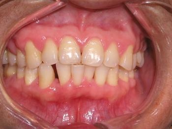 健康牙龈正常图片