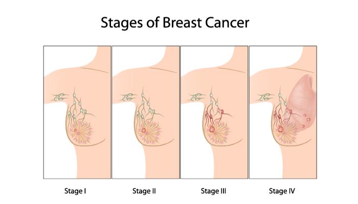 原位乳腺癌并不致命;但由于乳腺癌细胞丧失了正常细胞的特性,细胞之间