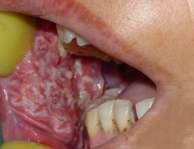 口腔癌图片 早期 初期图片