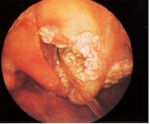咽后壁癌图片