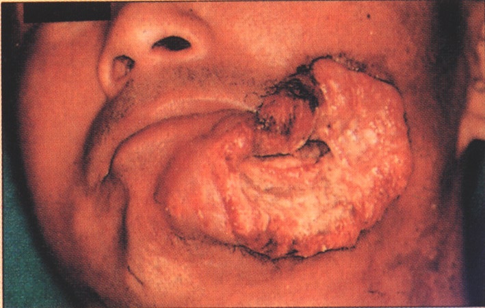 口腔癌手术后图片图片