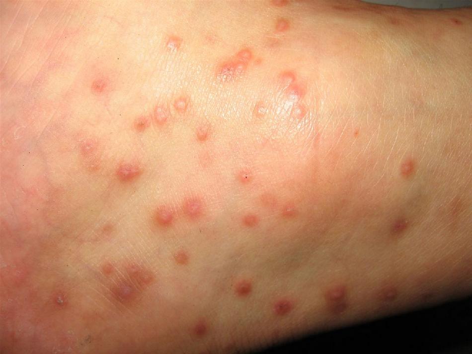 皮肤病疥疮怎么引起的图片
