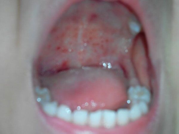 咽颊炎疱疹症状图片