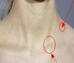 颈部淋巴瘤位置图片