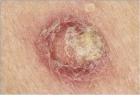 皮肤癌早期症状图片_癌早期的五个表现_癌早期皮肤有什么迹象