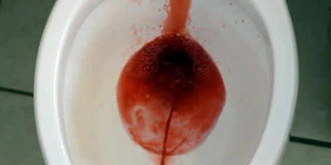 血尿在马桶中的图片