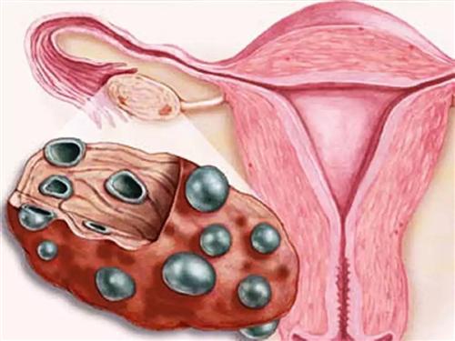 多囊卵巢综合征容易怀孕吗