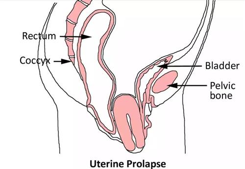 子宫下垂体外图片