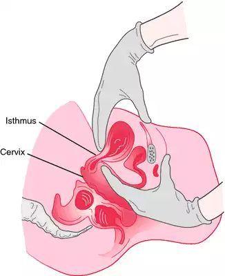 宫角妊娠解剖图片