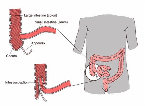 肠套叠症状图片