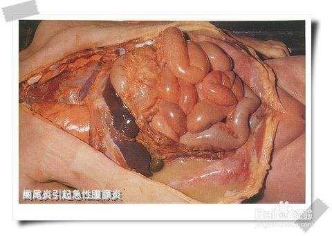 腹部脂膜炎图片