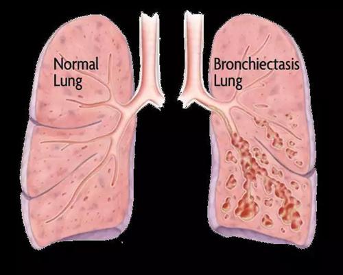 轻微支气管扩张的症状