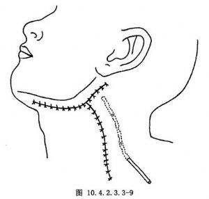 直接型頸動脈海綿竇瘻的原因