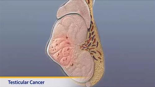 睾丸癌早期症状有哪些