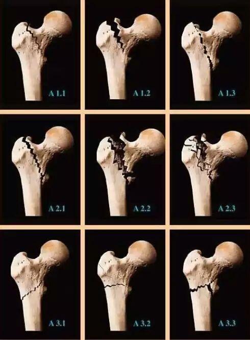 股骨粗隆间骨折部位图图片