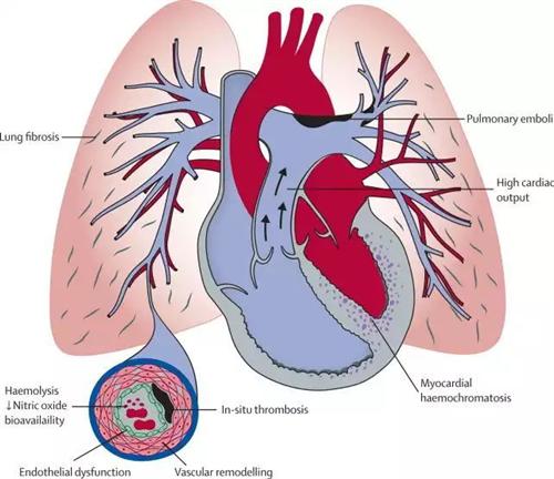 肺动脉示意图图片