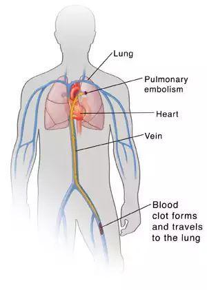 肺栓塞图片 示意图图片