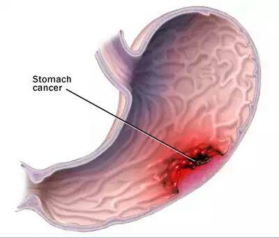 胃泌素瘤三角的示意图图片