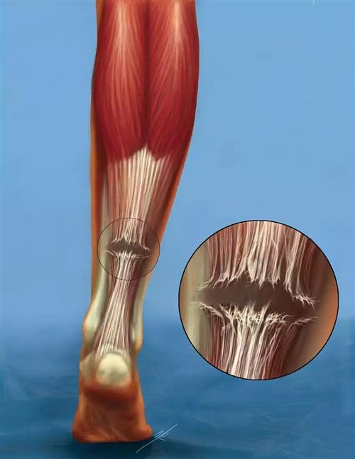 跟腱斷裂