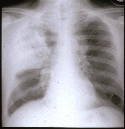 大叶性肺炎x线表现图片
