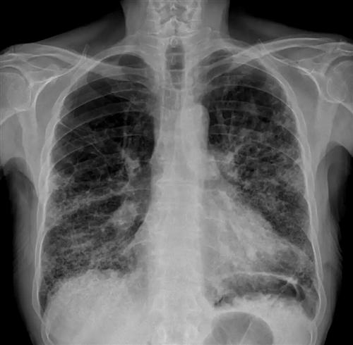 肺纤维化x线图片图片