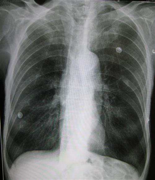肺气肿的影像图片图片