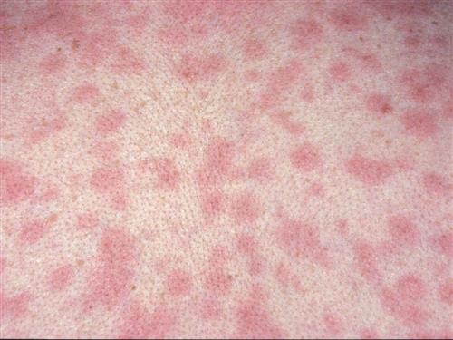 梅毒疹高清图片 一期图片