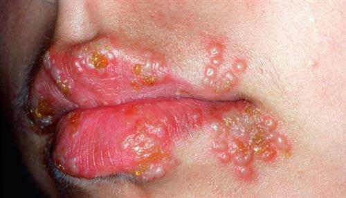 嘴唇疱疹的症状图片图片