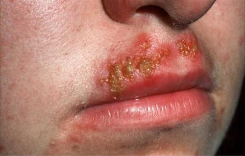 口唇疱疹病毒有什么症状?