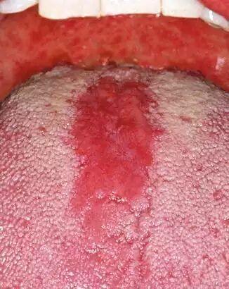 口腔链球菌感染图片
