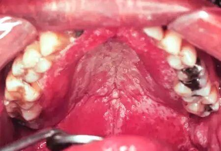 咽喉口腔真菌感染图片图片