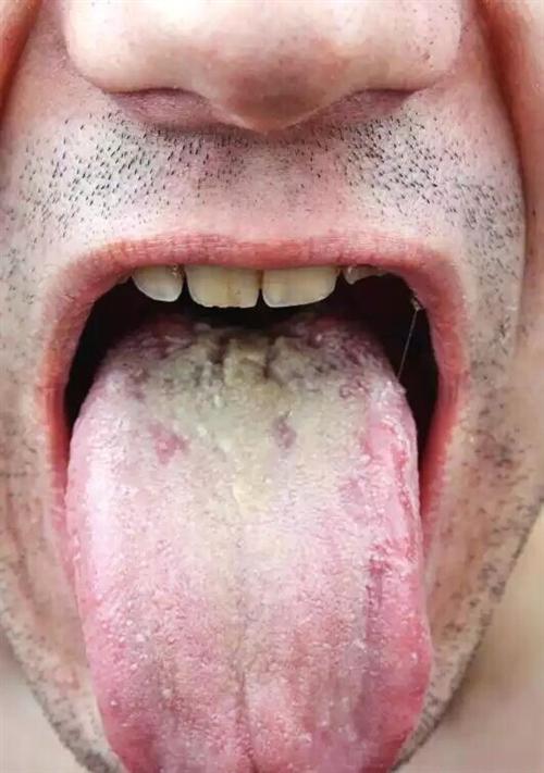 口腔念珠菌病舌头图片