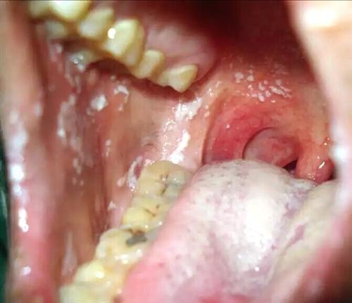 口腔真菌感染症状图片