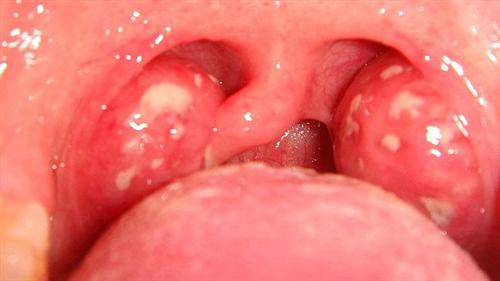 喉咙发炎吞咽口水都疼图片